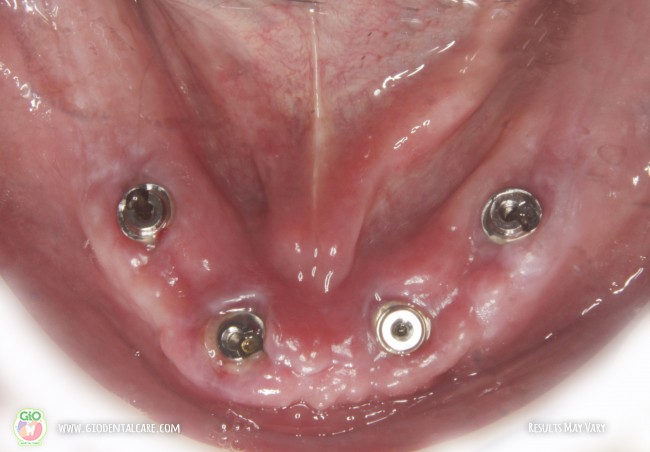 gio-dental-implants--implan-gigi